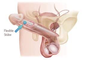 Biegsame-penisprothse-mit-flexiblen-staeben-anatomie-darstellung
